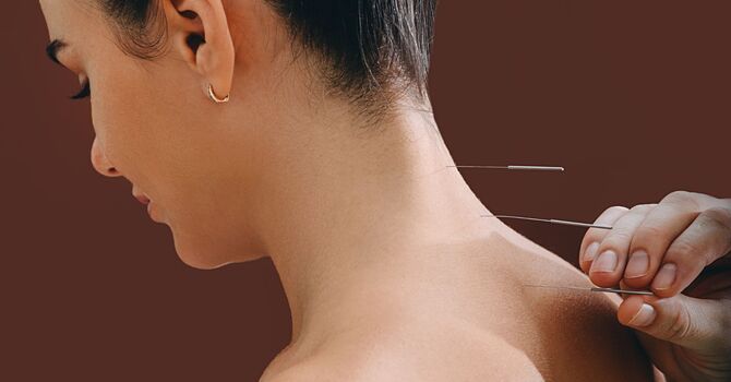 Cosmetic Acupuncture